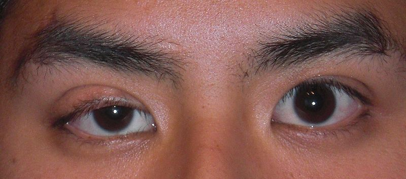 This image of a man's eyes shows the eyelid starting to droop over the eye, showing ptosis